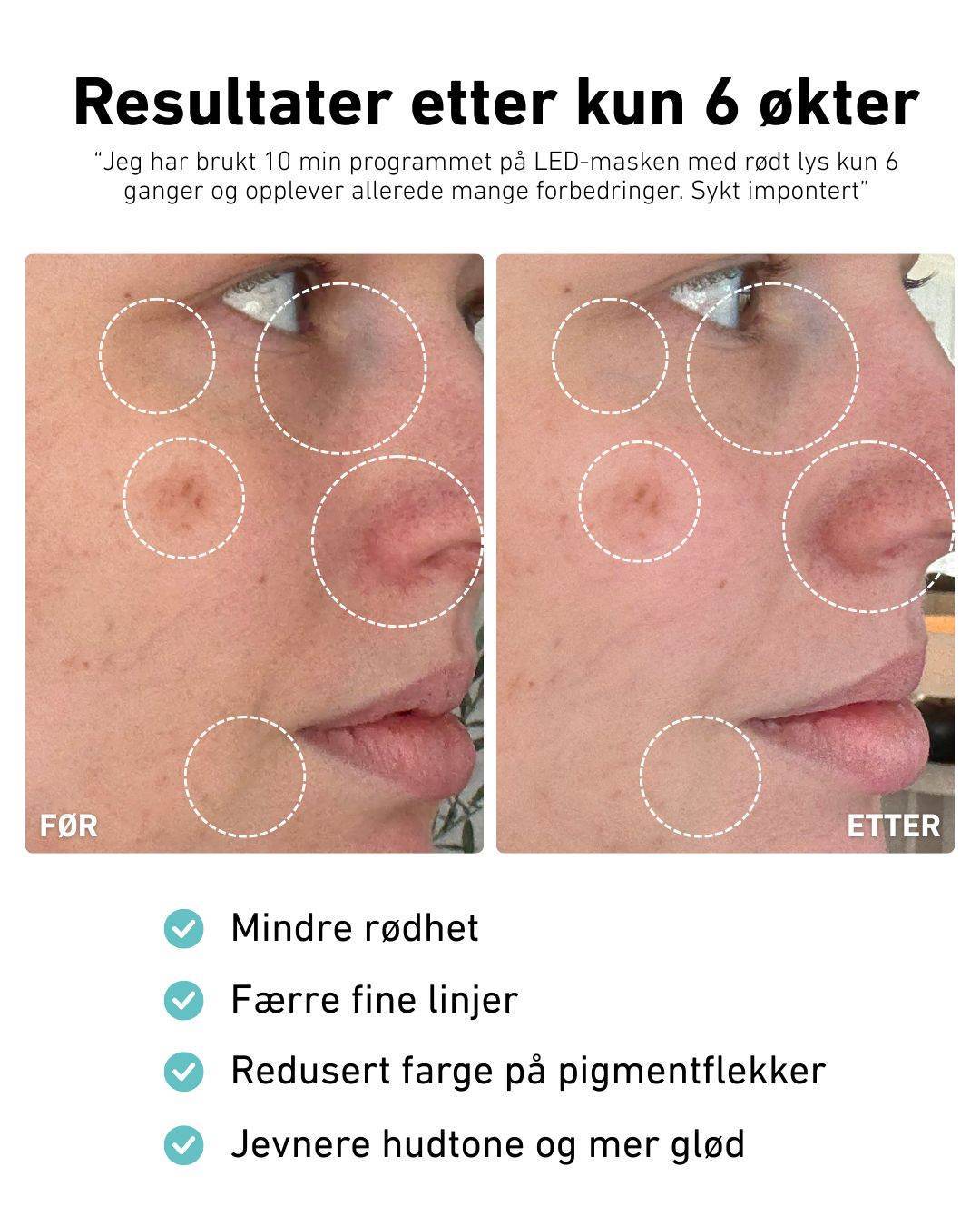 LED - lysmaske til ansikt mot akne, rynker og pigmentflekker - Lindas Dekor
