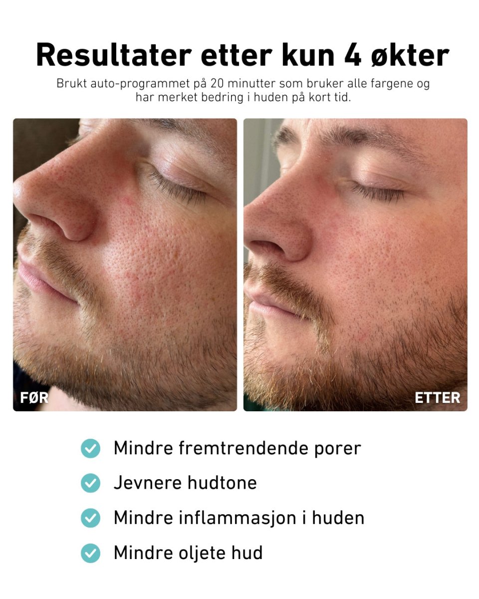 LED - lysmaske til ansikt mot akne, rynker og pigmentflekker - Lindas Dekor