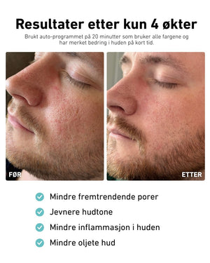 LED - lysmaske til ansikt mot akne, rynker og pigmentflekker - Lindas Dekor