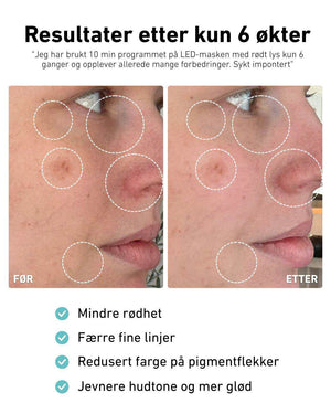 LED - lysmaske til ansikt mot akne, rynker og pigmentflekker - Lindas Dekor